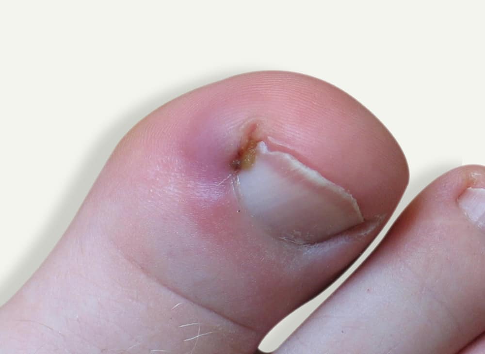 Ingrown Toenail Davenport House Clinic 5103