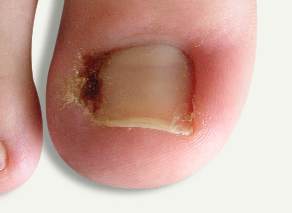 ingrown toenail